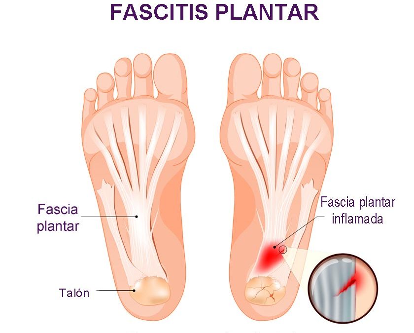 ¿Qué es una fascitis plantar?